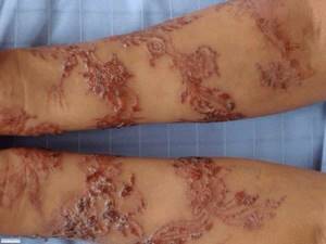 Allergy to henna tattoo