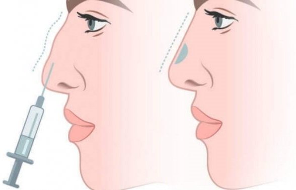 Длинный нос у девушки. Фото до и после ринопластики