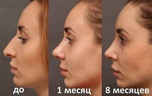Длинный нос у девушки. Фото до и после ринопластики