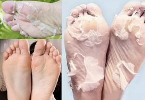 До и после использования китайских педикюрных носков