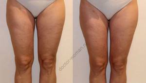 The effectiveness of lymphatic drainage massage in the fight against cellulite before and after
