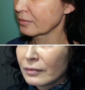 how to remove sagging cheeks: before and after photos