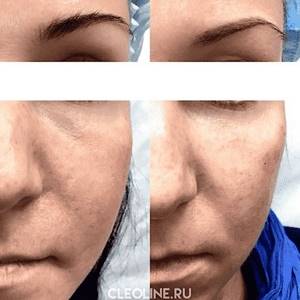 Contour plastic surgery after 50 years