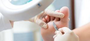 Treatment of hyperkeratosis in medical pedicure