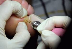 Treatment of calluses with medical pedicure