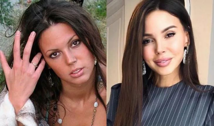 Oksana Samoilova before and after plastic surgery