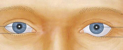 Опущенные уголки глаз операция. Кантопексия – простая операция для коррекции формы век