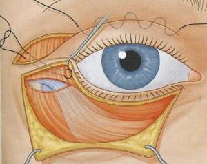Drooping corners of the eyes surgery. Canthopexy is a simple operation to correct the shape of the eyelids 