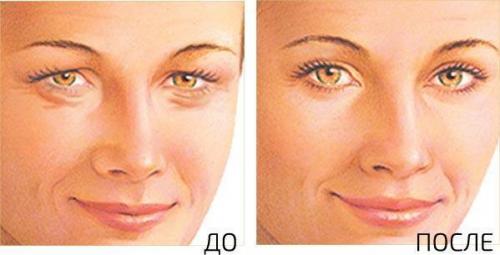 Drooping corners of the eyes surgery. Canthopexy is a simple operation to correct the shape of the eyelids 