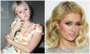 Paris Hilton before and after plastic surgery