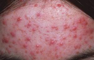 Pyoderma on the forehead