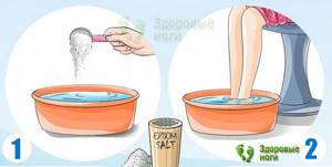 For heel spurs, salt baths have an analgesic and anti-inflammatory effect