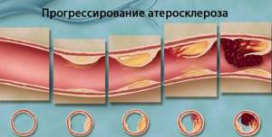 Development of atherosclerosis somuda