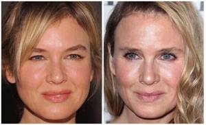Renee Zellweger before and after plastic surgery