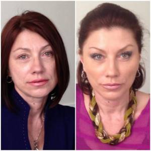 Rosa Syabitova before and after beauty injections