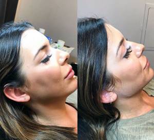 Cheekbones with hyaluronic acid: BEFORE and AFTER photos