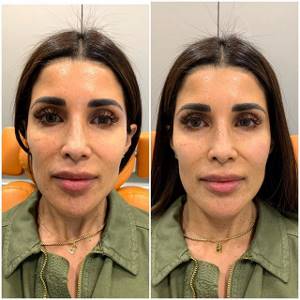 Cheekbones with hyaluronic acid: BEFORE and AFTER photos