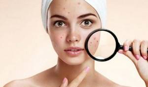 Anti-acne remedy