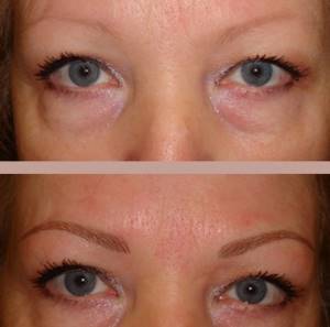 eyebrow tattoo removal with laser reviews