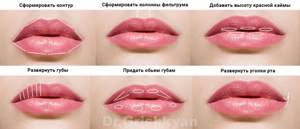 Lip augmentation based on hyaluronic acid